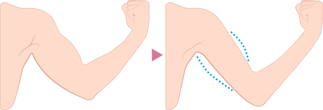 二の腕のボトックス痩身　施術方法
