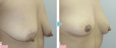 乳房吊り上げ術の症例写真