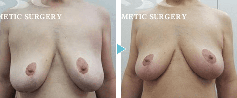 乳房縮小術の症例写真