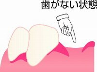 インプラント
