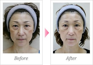 RegenSkin SRS Mask Pack