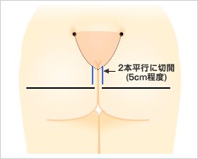 ヒップアップ プロテーゼ
