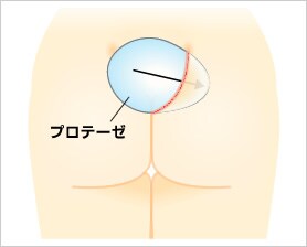 ヒップアップ プロテーゼ