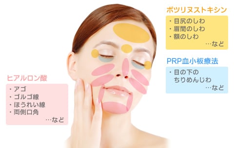 プチ若返り セット(ボトックス、ヒアルロン酸、PRP血小板療法)