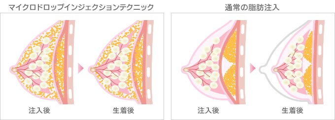 マイクロドロップインジェクションテクニックと通常の脂肪注入との比較