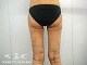 VASER(ベイザー)脂肪吸引施術後