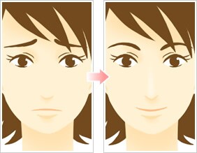 美容整形 団子鼻解消術(鼻尖形成)