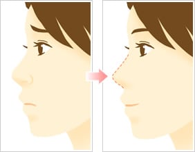 美容整形 切らない小鼻縮小術
