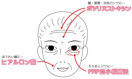 プチ若返り セット(ボトックス、ヒアルロン酸、PRP血小板療法)