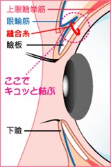瞼板
