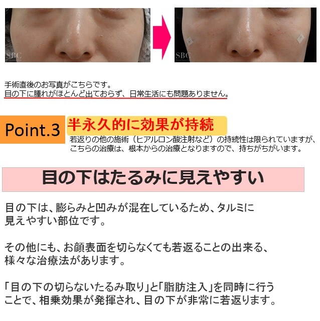 目の下の切らないたるみとり 特徴2