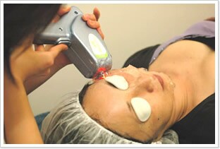 レーザー照射の様子