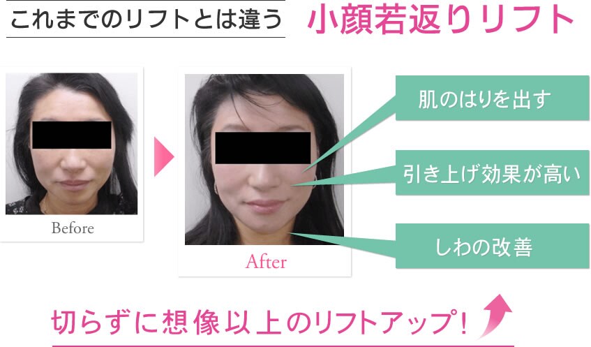 これまでのリフトとは違う 小顔若返りリフト