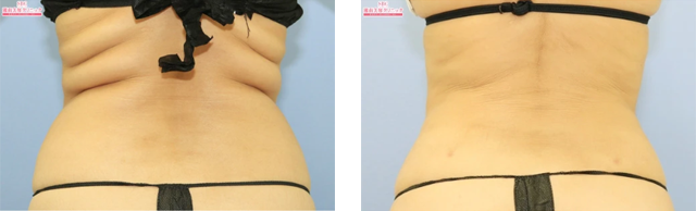 高川裕也医師｜ライポマティック脂肪吸引、根こそぎVASER脂肪吸引｜施術前後の症例写真