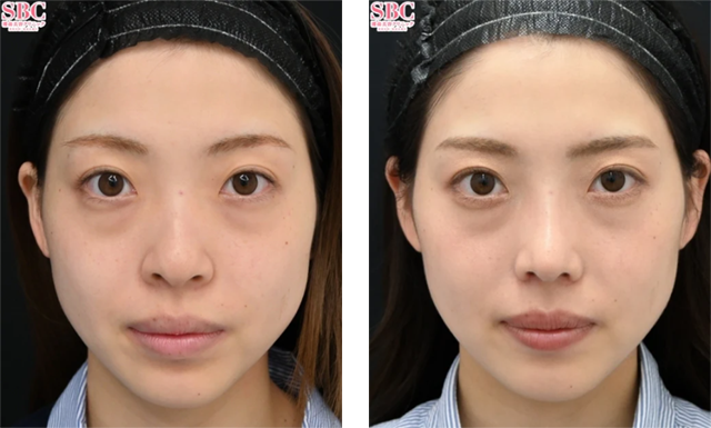 中野達生医師｜SBCプレミアムソフトプロテーゼ、鼻尖形成術3D法、小鼻縮小（フラップ）｜施術前後の症例写真