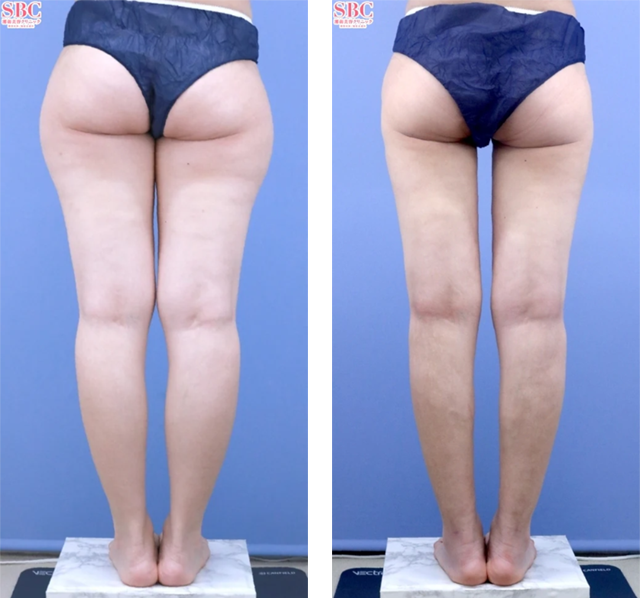須田陽一医師｜Aquicell（アキーセル）脂肪吸引、根こそぎVASER脂肪吸引、ライポマティック脂肪吸引｜施術前後の症例写真