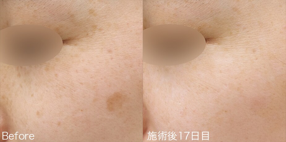 シミ取りレーザー 症例写真