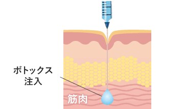 しわにボトックス注入