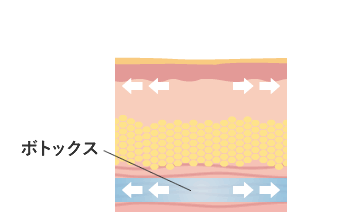 ボトックス注入後