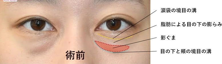 涙袋との見分け方