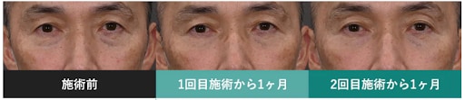 モフィウス８症例写真