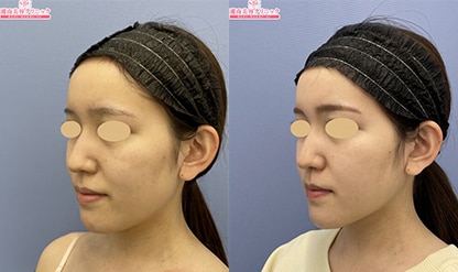アキーセル脂肪吸引(ホホ+アゴ下+エラ下) 症例写真 No.298944