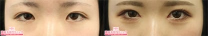 目頭切開プレミアム 症例写真