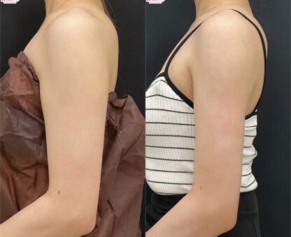 美ボディ脂肪吸引 症例写真