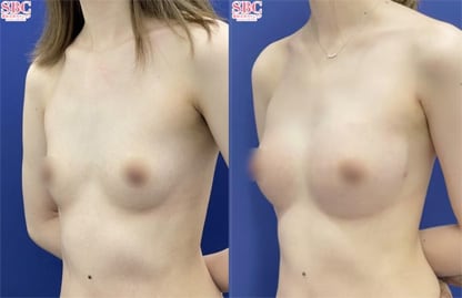 週末豊胸 -ピュアグラフト- 症例写真