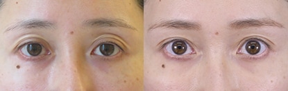 切らない眼瞼下垂 真崎式 症例写真