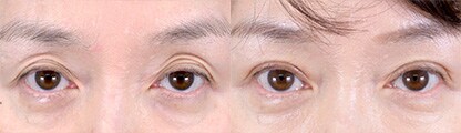 切らない眼瞼下垂 真崎式 症例写真2