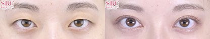 クイックコスメティークNeoトリプル 症例写真
