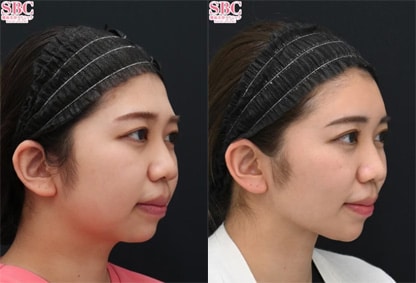 顔の脂肪注入 症例写真