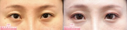 目尻切開法 症例写真