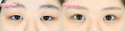 全切開法二重術 症例写真