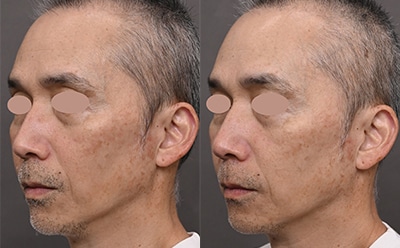 フォトジェネシス 症例写真