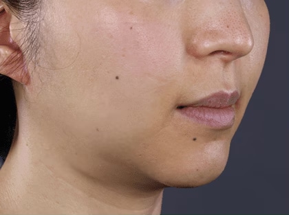 ウルトラリフトプラスHIFU+新・脂肪溶解リニアハイフ 症例写真 Before