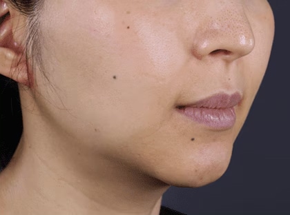 ウルトラリフトプラスHIFU+新・脂肪溶解リニアハイフ 症例写真 After