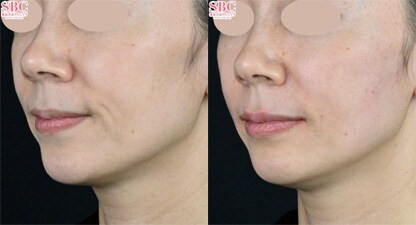 ヒアルロン酸 症例写真