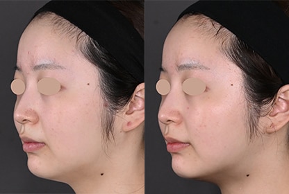 新・脂肪溶解リニアハイフ 症例写真