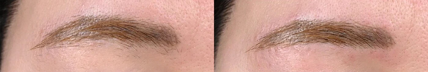 シミ取りレーザー 症例写真 Before After