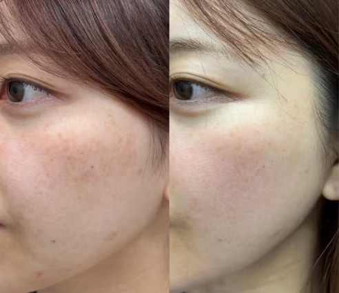 ピコレーザーホワイトニング 症例写真