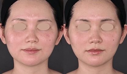 水光注射 症例写真