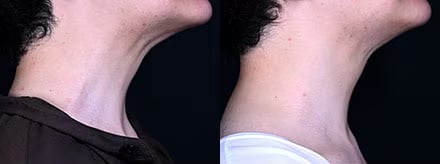 頸部ボトックスまたはボトックスリフト 症例写真 Before After