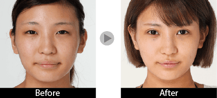 眼瞼下垂＋二重1