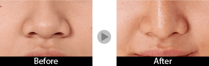 小鼻縮小（内側外側法）2