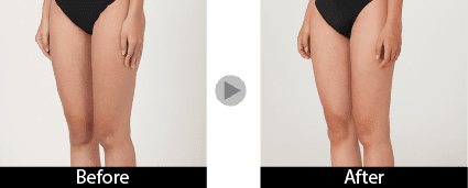 ベイザー脂肪吸引（大腿・臀部・膝）1