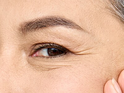 皮膚が薄い目尻や目の下