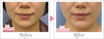 エラボトックスの症例写真