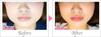 エラボトックスの施術1ヵ月後の症例写真